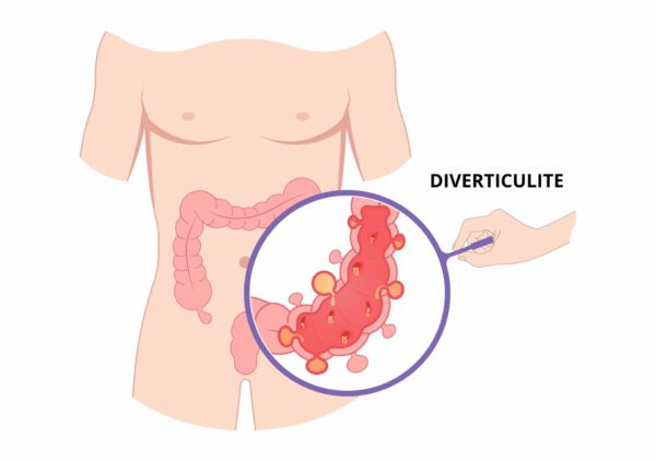 Agrandissement du colon - zoom diverticule