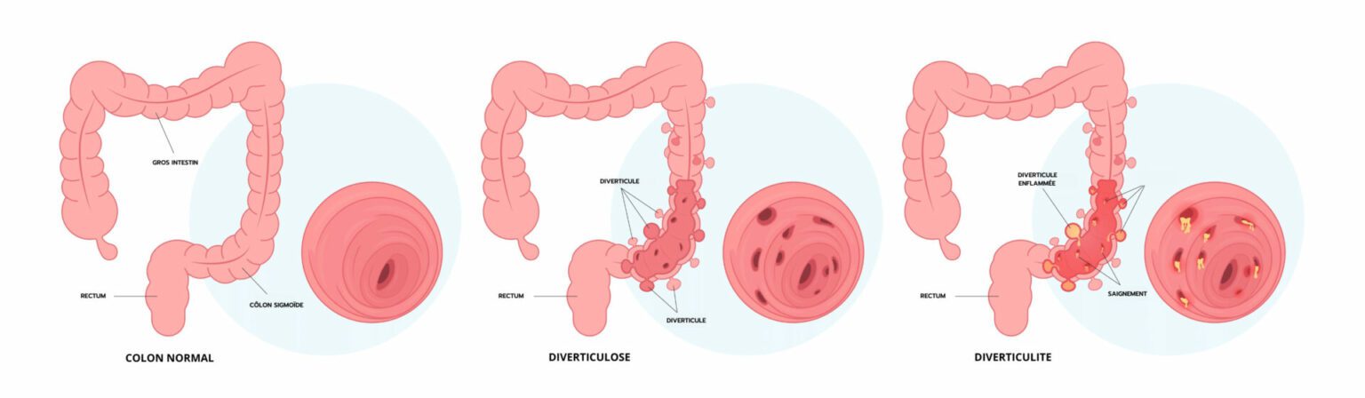 différence entre diverticule - diverticulite et diverticulose